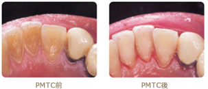 PMTC施術前後